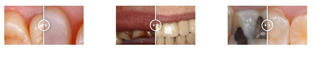 dental-bridge-treatment-yarraville-melbourne-before-and-after-treatment