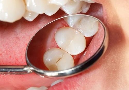 dental-porcelain-in-yarraville-melbourne