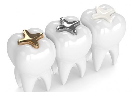 tooth-fillings-white-silver-gold-yarraville-dental